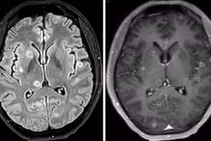 Hình ảnh MRI sọ não của người bệnh.