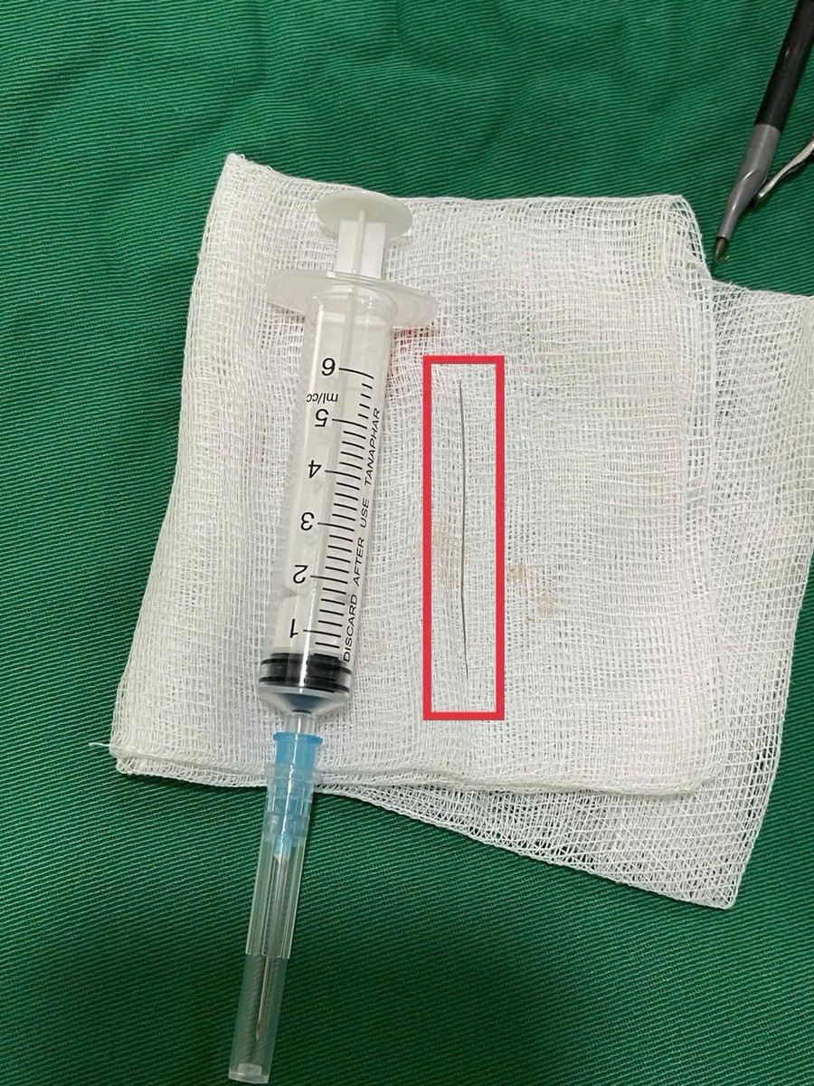 Dị vật được lấy ra thành công. Ảnh: Khoa Ngoại Tổng Hợp 2 - Bệnh viện Thanh Nhàn. z6919510908105-18218e59a48acff564cda264c29be15f.jpg