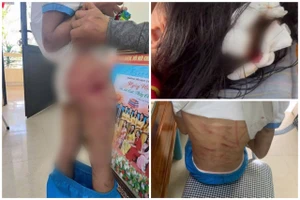 Bé gái nhập viện với nhiều vết thương trên cơ thể.