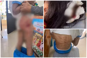 Bé gái nhập viện với nhiều vết thương trên cơ thể.