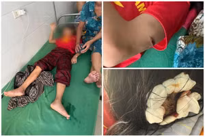 Học sinh lớp 5 đang điều trị tại bệnh viện với nhiều vết thương trên cơ thể. Ảnh: TG