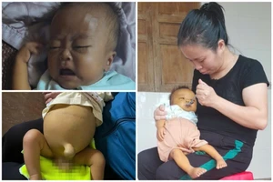Mới 7 tháng tuổi, bé Phong phải chịu quá nhiều nỗi đau về thể xác.