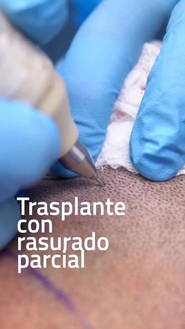Thủ môn của nhà á quân Ngoại hạng Anh còn khoe 1 số đoạn clip ghi lại quá trình cấy ghép tóc. Arsenal05.jpeg