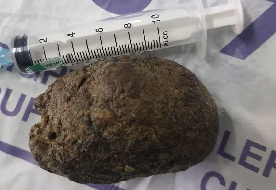 Khối thức ăn trong dạ dày của bệnh nhân. Ảnh: BVCC