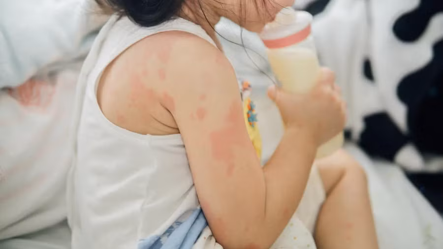 bat benh nhiem trung da1.jpg