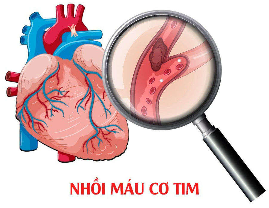 thieu mau co tim cuc bo (1).jpg