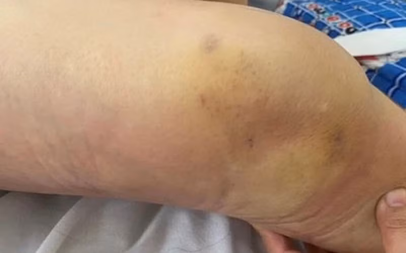 Khớp nhiễm khuẩn, viêm tấy lan tỏa cẳng chân. Nguồn: Bệnh viện Đa khoa tỉnh Thái Bình