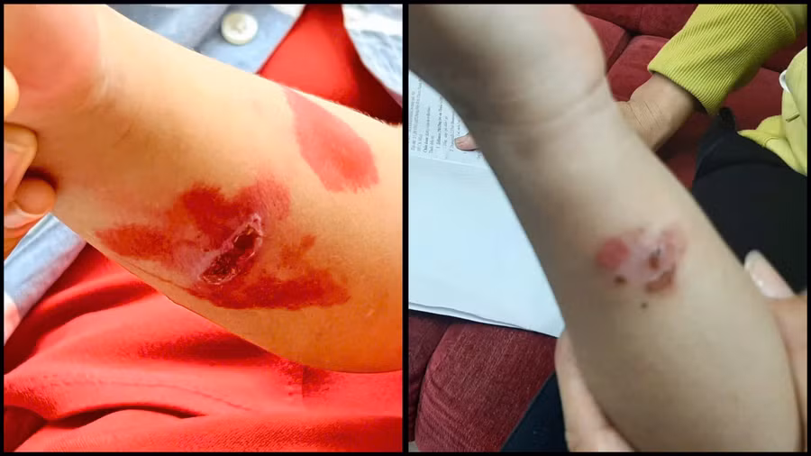 de phong benh choc lay lan o tre (1).jpg