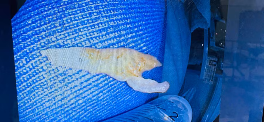 Dị vật là một đoạn xương gà kích thước khoảng 5cm. Ảnh: TTYT Tiên Yên