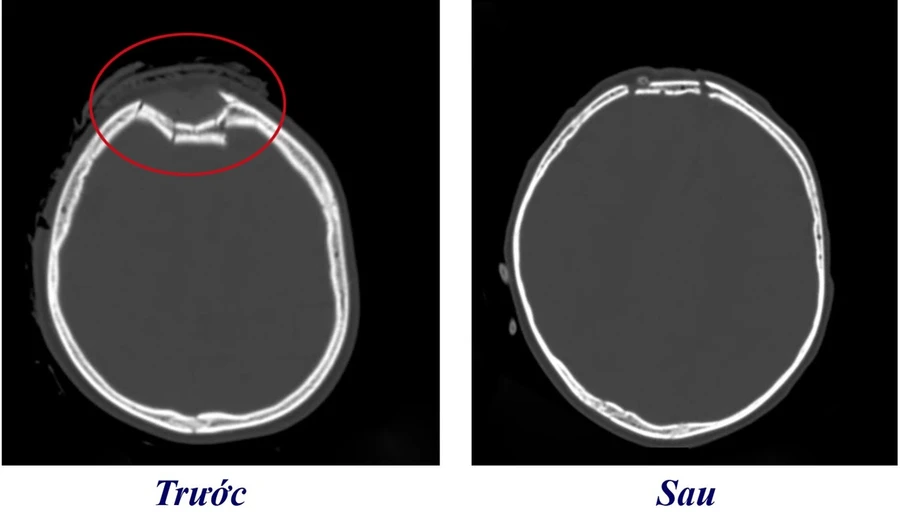 Hình ảnh vùng sọ não bị lún của trẻ trước và sau khi phẫu thuật. Ảnh: BVCC 