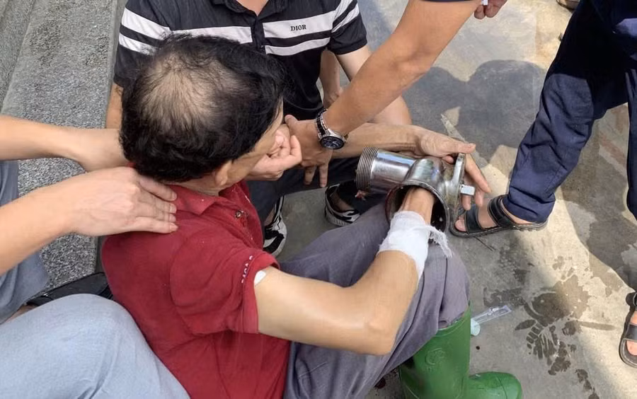 Người đàn ông nhập viện cấp cứu với máy xay thịt dính trên tay phải.