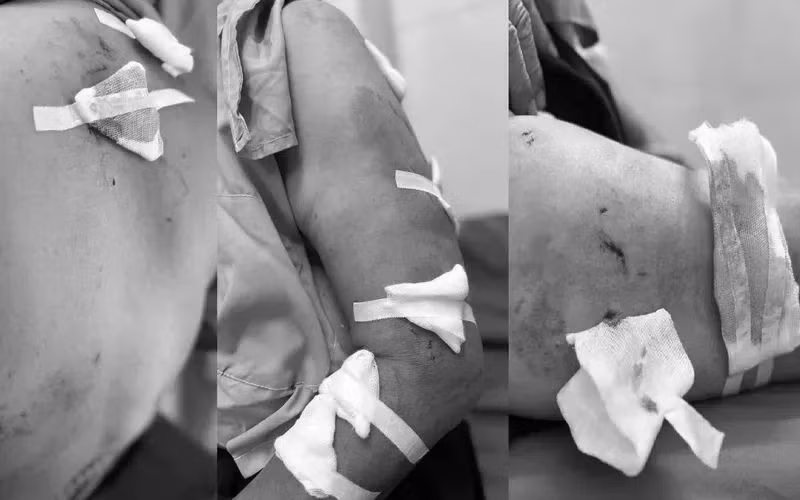 Cụ bà 77 tuổi bị đa chấn thương do đàn chó cắn.