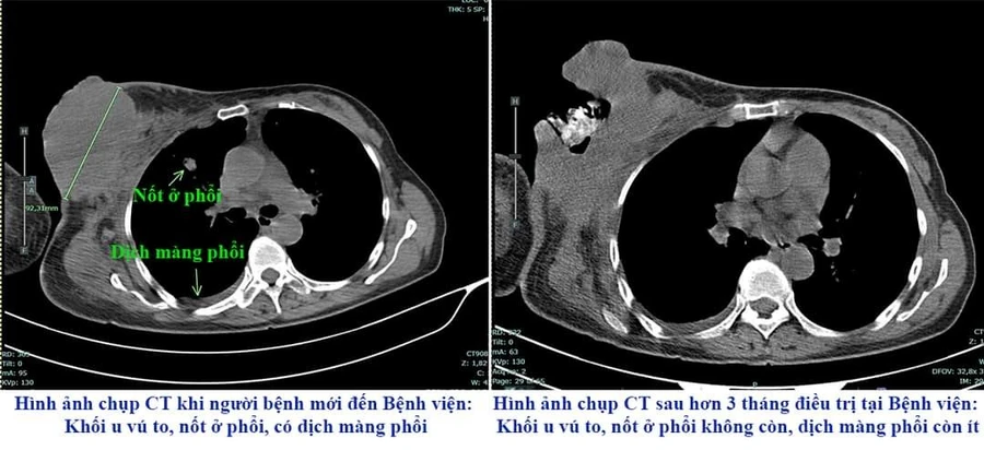 Đắp thuốc nam để điều trị, người bệnh bị vỡ, loét khối u. (Ảnh: BVCC)