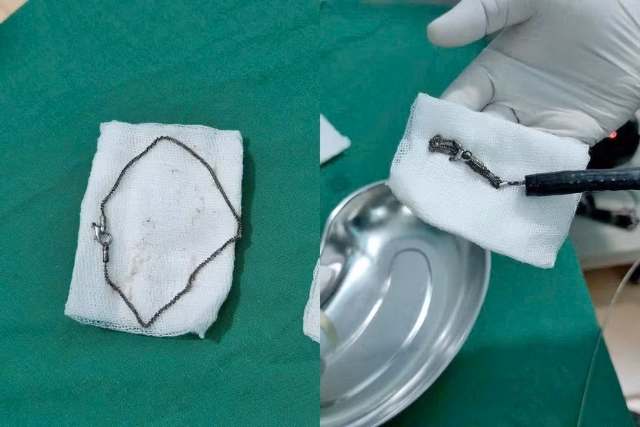 Sợi dây chuyền bé gái nuốt phải được các bác sĩ lấy ra.