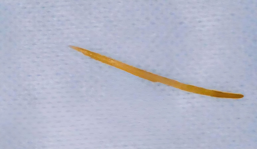 Xương cá dài 5cm được phát hiện khi bệnh nhân đi khám.