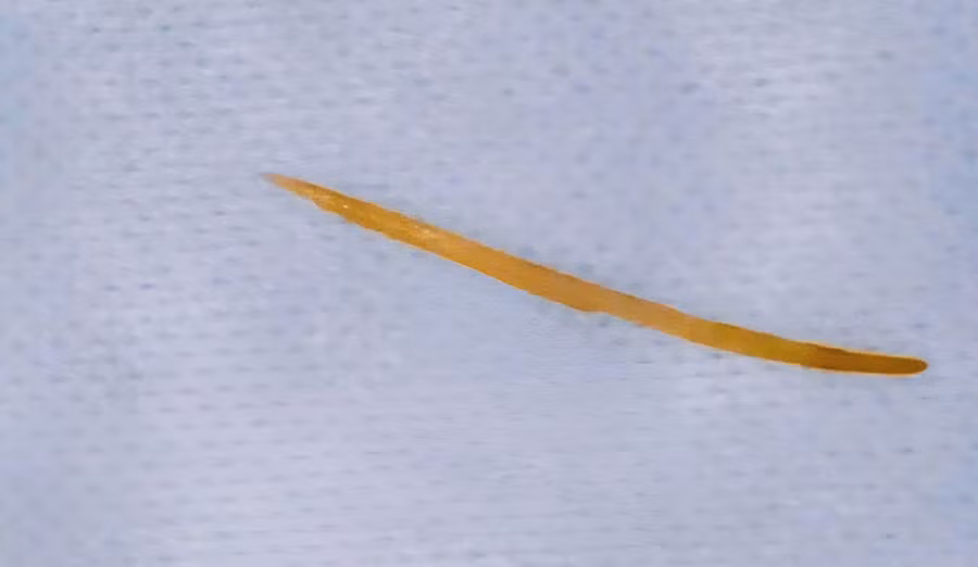 Xương cá dài 5cm được phát hiện khi bệnh nhân đi khám.