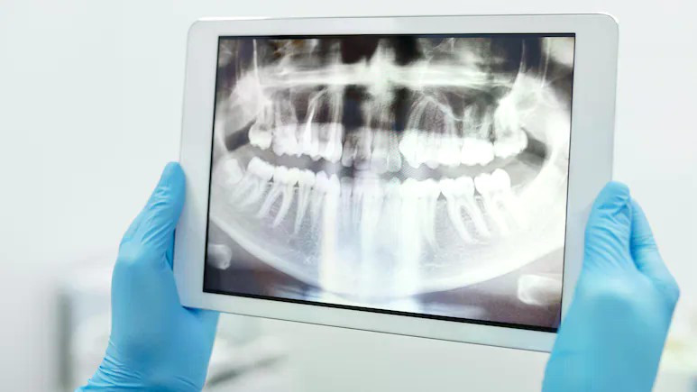 Trong quá trình phẫu thuật, bác sĩ đã nhổ nhầm một chiếc răng khỏe mạnh của bệnh nhân. Ảnh minh hoạ.