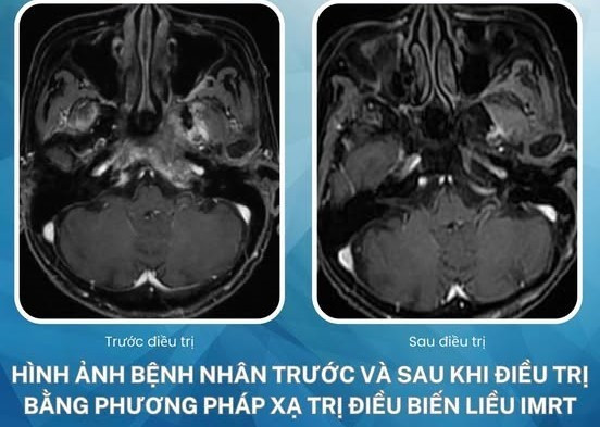 Sau 15 tháng theo dõi, sức khỏe của bệnh nhân ổn định, không có dấu hiệu tái phát hay biến chứng nghiêm trọng. Ảnh: BVCC.