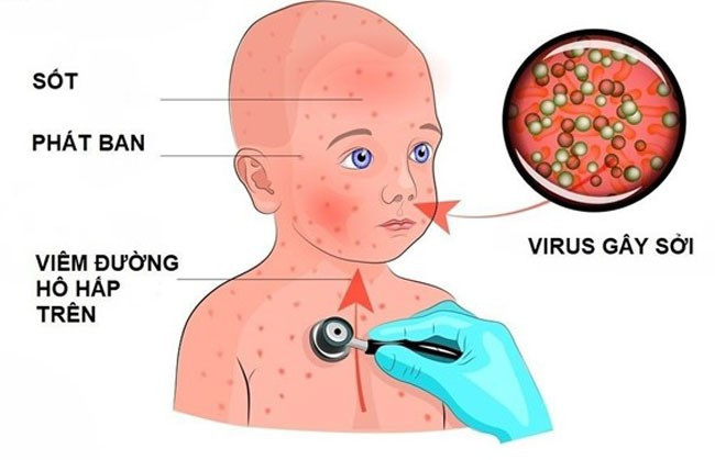 Nếu không được phát hiện sớm và điều trị kịp thời, bệnh sởi có thể gây những biến chứng nguy hiểm.