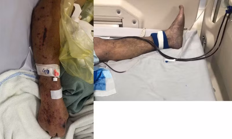 Bệnh nhân được chẩn đoán sốc nhiễm khuẩn - nhiễm khuẩn huyết - viêm phổi, trên nền tăng huyết áp, tiên lượng tử vong rất cao. Ảnh: BVCC. 