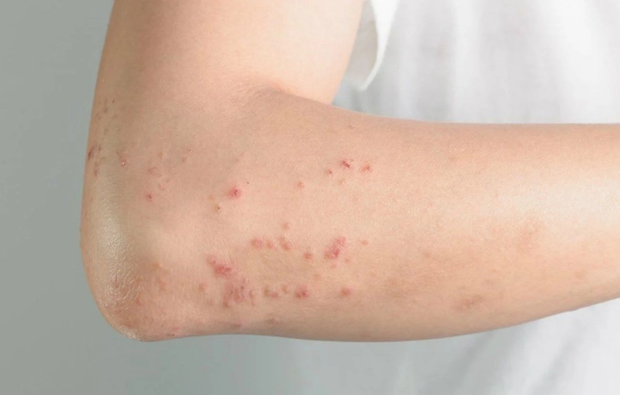 Sởi có thể dẫn đến các biến chứng nghiêm trọng. Ảnh minh hoạ. 