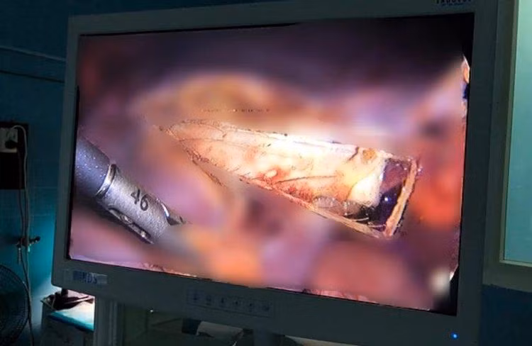 Mảnh thuỷ tinh dài 9 cm trong gan bệnh nhân. 