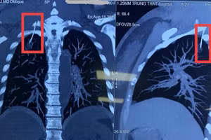 Hình ảnh chụp cắt lớp vi tính dựng hình phát hiện dị vật chọc vào màng phổi phải bệnh nhân. Ảnh: Khoa Ngoại Tổng Hợp 2 - Bệnh viện Thanh Nhàn.