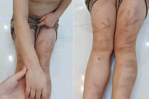 6 trẻ Trường Mầm non Nghĩa Lộc bị bạn đánh bầm tím cơ thể.