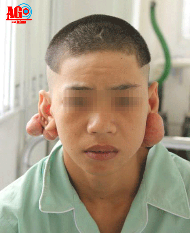 Xỏ nhiều lỗ tai, thanh niên 17 tuổi bị khối u to, biến dạng tai ảnh 2 Xỏ nhiều lỗ tai, thanh niên 17 tuổi bị khối u to, biến dạng tai