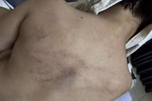 Biểu hiện bầm tím trên lưng bé L.