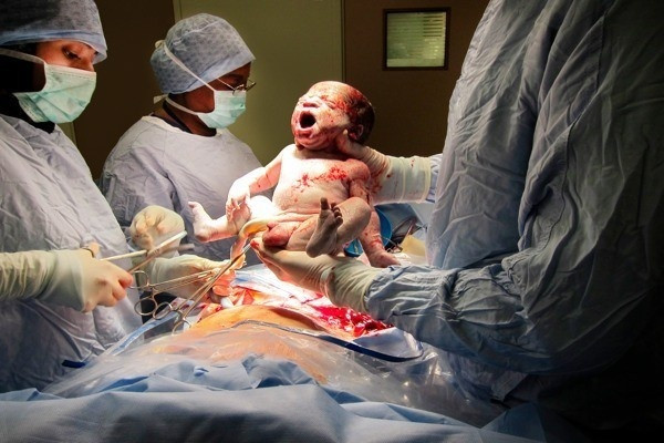 Sự thật về lý do bé sinh mổ thường quấy khóc nhiều hơn bé sinh thường?