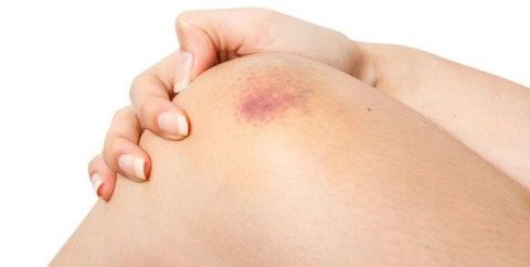 Vết bầm tím xuất hiện khi mạch máu bị tổn thương. 