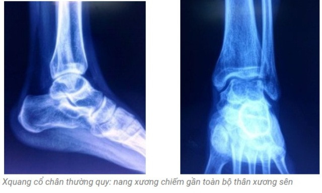 Đau cổ chân kéo dài, nam thanh niên mắc bệnh hiếm gặp mà không hề biết 1 dau-co-chan-keo-dai-nam-thanh-nien-mac-benh-hiem-gap-ma-khong-he-biet-1