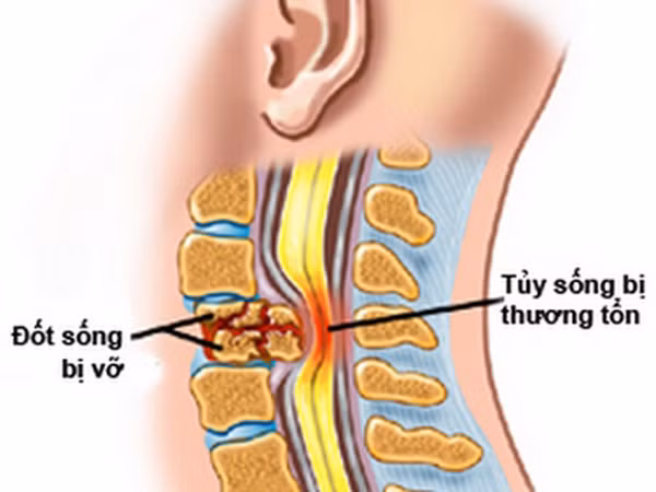 Bé gái 6 tuổi bị liệt nửa người vì cố uốn dẻo khi học múa