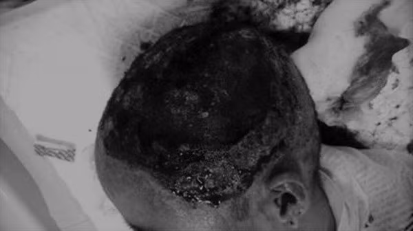  Tại thời điểm vào viện, cô gái bị bỏng 2% tổn thương bỏng sâu toàn bộ da đầu, hoại tử và mô hạt. Ảnh: BS cung cấp. 