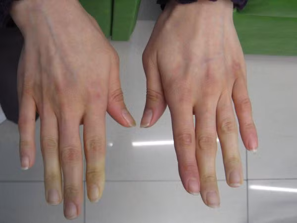 10 biểu hiện bất thường trên tay đang ngầm tố cáo” hàng loạt vấn đề sức khỏe mà bạn không ngờ đến-3