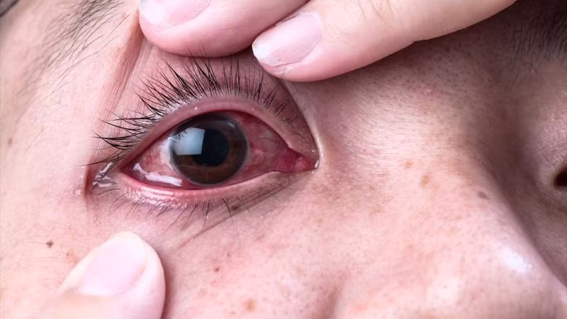 Đau mắt đỏ có thể do nhiều nguyên nhân khác nhau. (Ảnh minh hoạ)