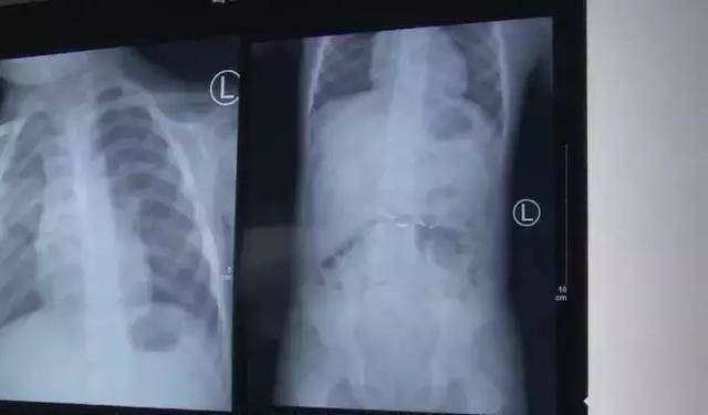 Bé 2 tuổi cắn vỡ nhiệt kế nuốt phải thủy ngân, bác sĩ cho uống ngay thứ này ảnh 3 be 2 tuoi can vo nhiet ke, nuot phai thuy ngan, bac si noi: "uong ngay them thu nay" - 5