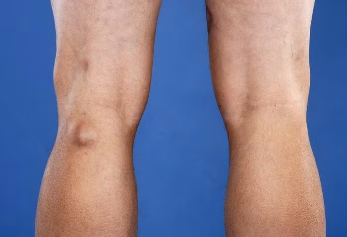 Theo bác sĩ đây mới chính là 9 lý do khiến bạn bị sưng đầu gối 