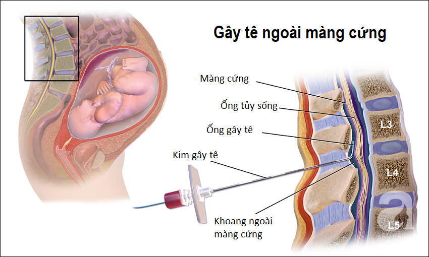 Tất tật những điều các mẹ cần biết về phương pháp giảm đau phổ biến khi sinh nở