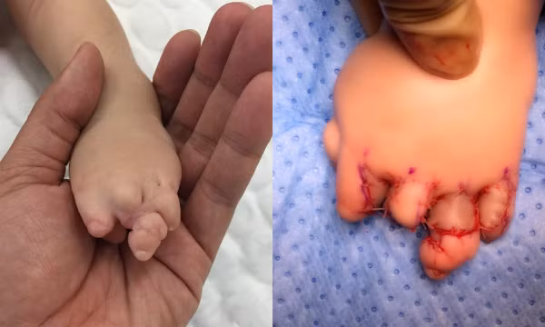 Hội chứng bẩm sinh hiếm gặp khiến bé gái dính ngón tay, chân