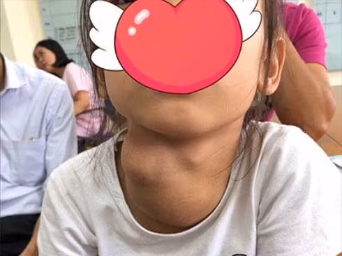  Bệnh nhi với khối u tuyến giáp có kích thước lớn trước khi phẫu thuật 