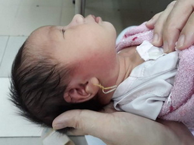 Bé 15 ngày tuổi suýt chết vì xỏ lỗ tai
