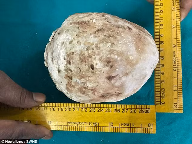 Đây được xem là viên sỏi canxi lớn nhất được tìm thấy trong cơ thể người tại Ấn Độ.