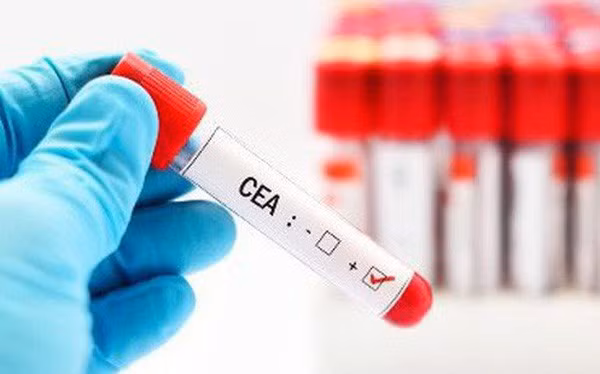  Các xét nghiệm máu quảng cáo phát hiện ung thư không có giá trị chẩn đoán 