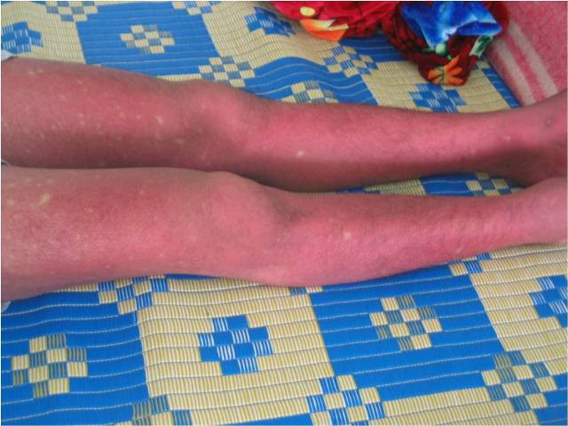 Những dấu hiệu cảnh báo nguy hiểm của Sốt xuất huyết ảnh 2