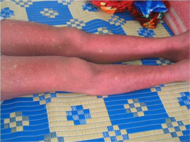 Những dấu hiệu cảnh báo nguy hiểm của Sốt xuất huyết ảnh 2