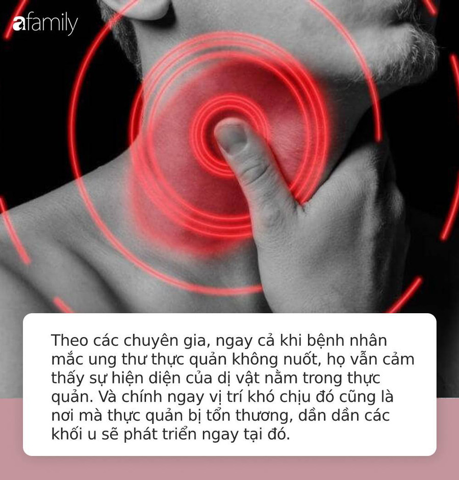 Thấy 6 dấu hiệu lạ này ở cổ họng, bạn phải tới bác sĩ ngay bởi có thể đã mắc ung thư thực quản - Ảnh 4. Thấy 6 dấu hiệu lạ này ở cổ họng, bạn phải tới bác sĩ ngay bởi có thể đã mắc ung thư thực quản - Ảnh 4.
