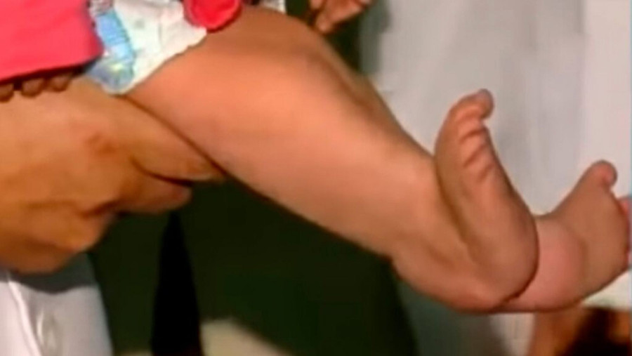 Hội chứng “nàng tiên cá” hai chân dính chặt vào nhau, thường tử vong 24 giờ sau sinh ảnh 1 Sức khỏe - Bệnh lạ: Hội chứng