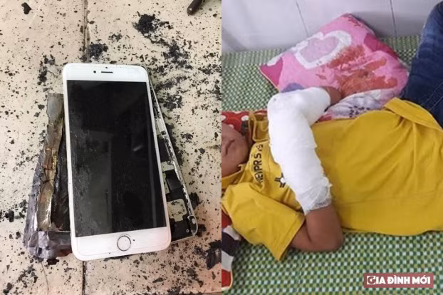  Hai bàn tay của cậu bé bị dập nát do điện thoại nổ 